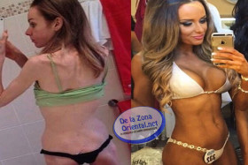 anorexia